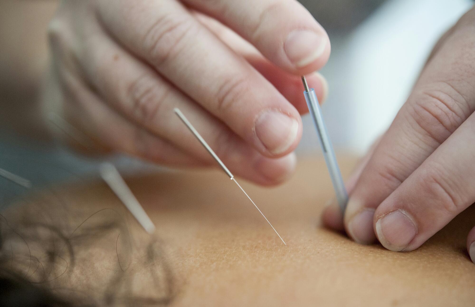 benefits of dry needling